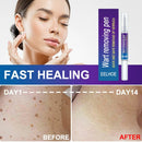 Of Warts Liquid Removing Against Moles Anti Verruca Remedy Warts Remover Pen