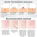 40 Capsules Acne Remover Patches Spot Scar Care Treatment K0T3 J4U2 L4V8 P7R9