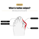 Foot Toe Separator Hallux Valgus Protector Thumb Concealer Bunion Foot Care Tool