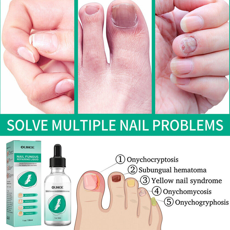 30ml Toenail Fungus Oil Nail Repair Liquid for Fingernails Anti Fungal Whitening