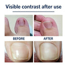 50pcs Ingrown Toenail Correction Stickers Visibly Effect Nail Corrector