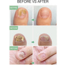 Nail Care Solution Finger Toenails Repair Anti-Fungal Essence Nutrition Liquid`