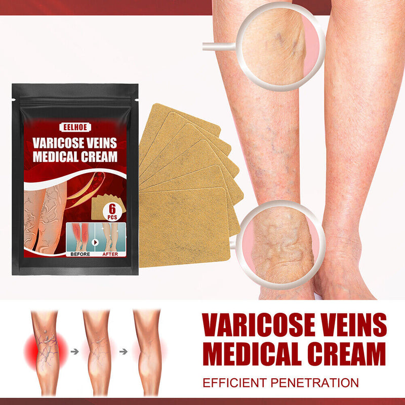 Body Vasculitis Phlebitis Spider Pain Relief Plaster Unisex Health Care Patch