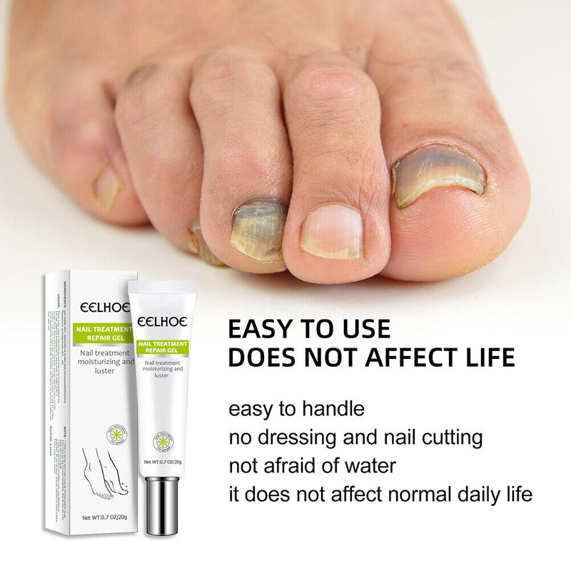 Paronychia Treatment Toe Health Foot Care Anti-Infection Gel