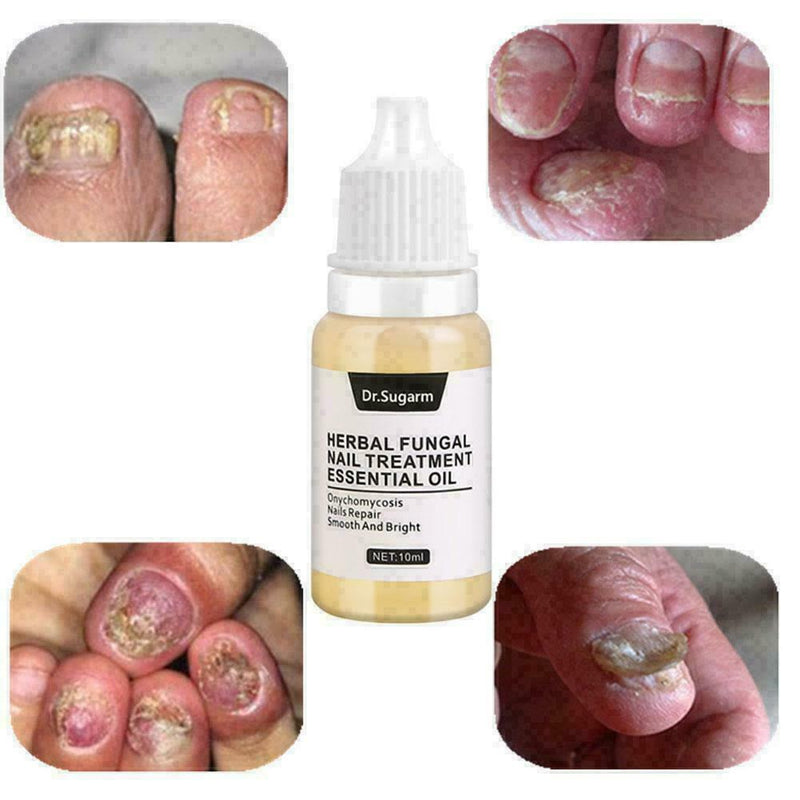 Nail Fungus Treatment Nail Oil Pen Anti Fungal Nail Remove Q4Y8 L0J1 C8K4
