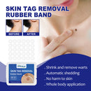 Rubber Skin Tag Remover Device Painless Safe Easy To Use Face Care Beauty Tools