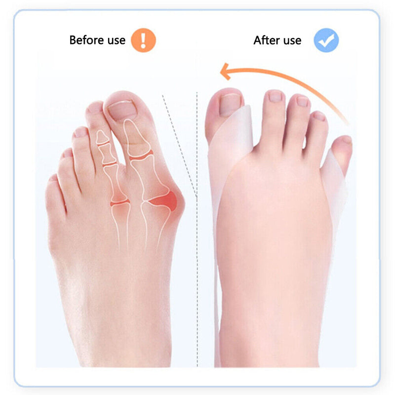 1pair Toe Thumb Orthotics Non-slip Toe Eversion Adjustment Bands Foot Care Tools