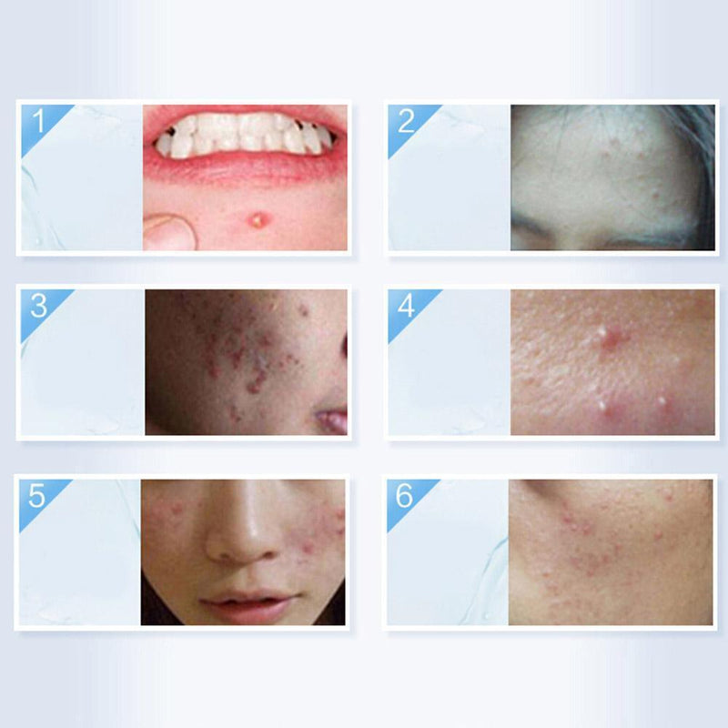 36pcs/bag Acne Pimple Master Patches Face Spot Scar Care Treatment Stickers