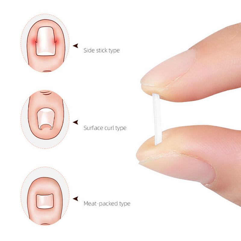 Ingrown Nail Filling Pad Relief Pain Nail Corrector Groove Pads (50pcs) Newly