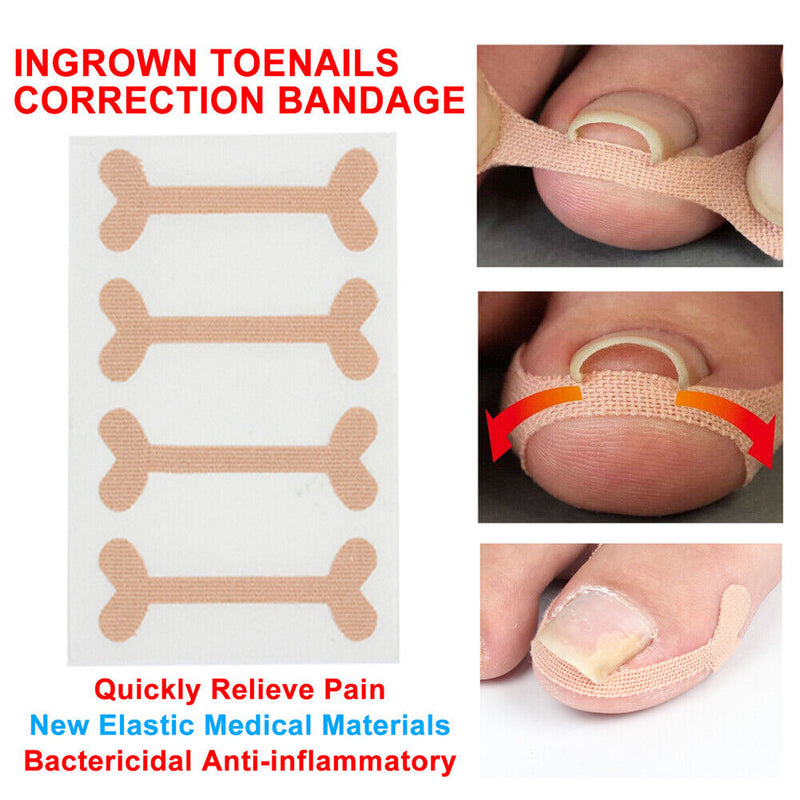 Ingrown Toenail Corrector Fixer Recover Kit Pedicure Nail Patch Foot Care Tool