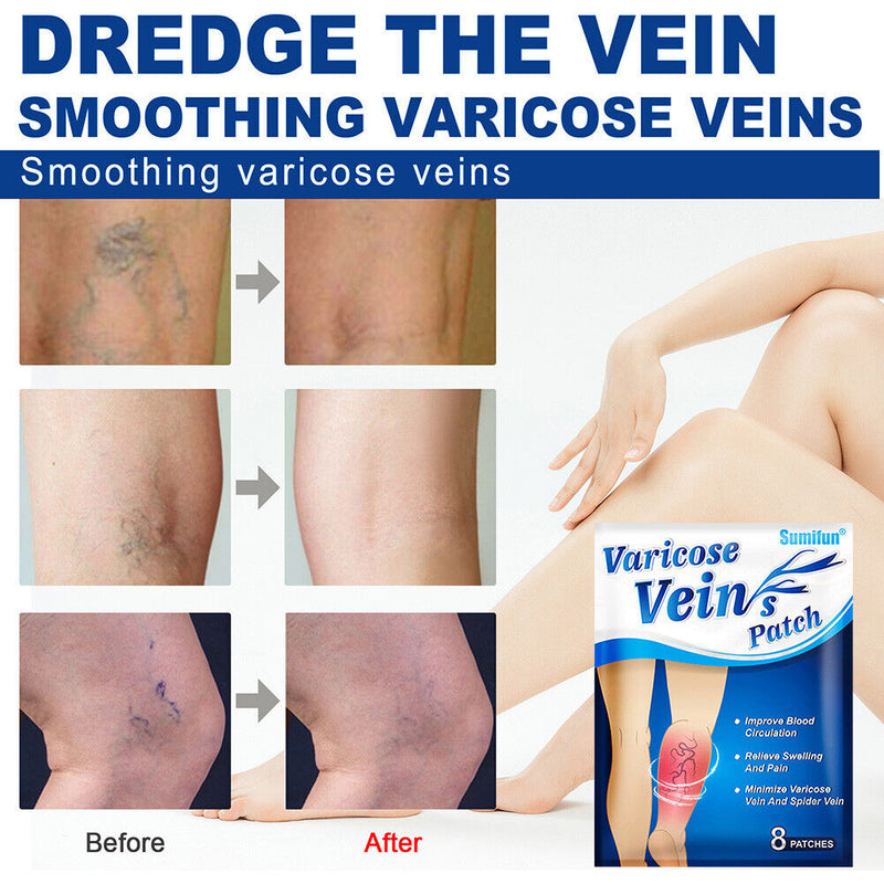 Varicose Vein Treatment Patches Pain Relief Vasculitis Phlebitis Herbal Pla