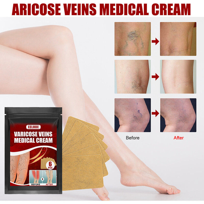 Body Vasculitis Phlebitis Spider Pain Relief Plaster Unisex Health Care Patch