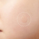 Invisible Wart Treatment Skin Tag Pimple Remover Acne Wart Remove Acne Patch