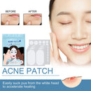 80pcs Acne Patches Pimple Remover Invisible Spot Stickers Facial Care Beauty