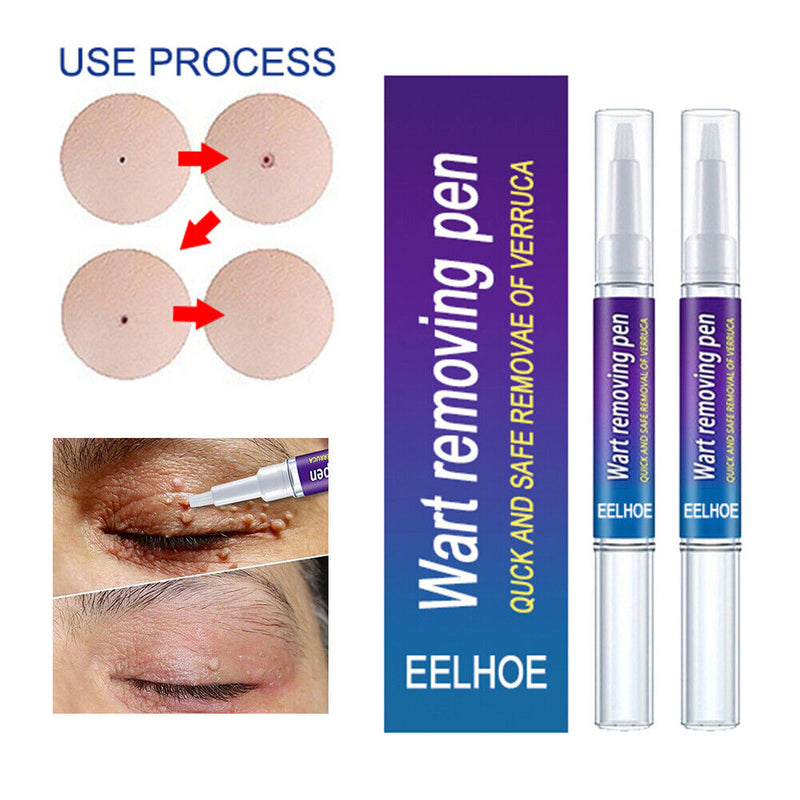 2pcs Wart Remover Skin Tag Pen Safe Herbal Ingredients Medicine Ointment Tools