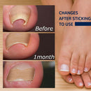 50pcs Ingrown Toenail Correction Stickers Visibly Effect Nail Corrector