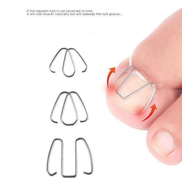 Easy To Use Correct Multiple Pedicure Front Hook Toenails Orthotics Rubber Band
