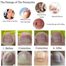 10pcs Ingrown Toenail Straightening Clip Curved Brace Toenails Correction
