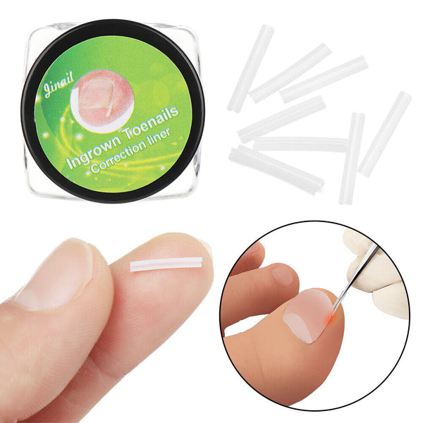 Wire Flexible Nail Corrector Artifact Ingrown Nail Pads Nail Groove Pad