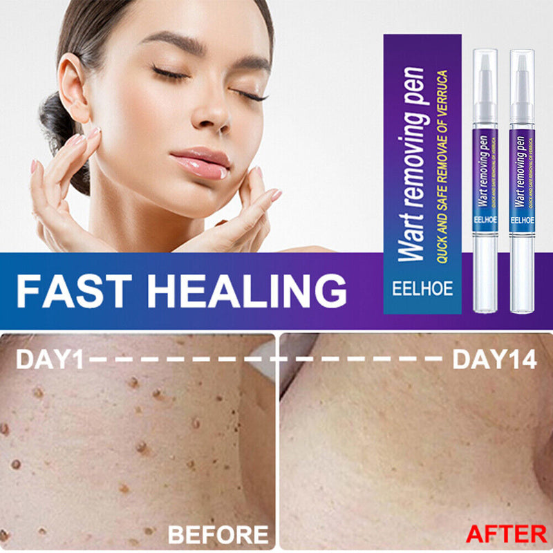 2pcs Wart Remover Skin Tag Pen Safe Herbal Ingredients Medicine Ointment Tools