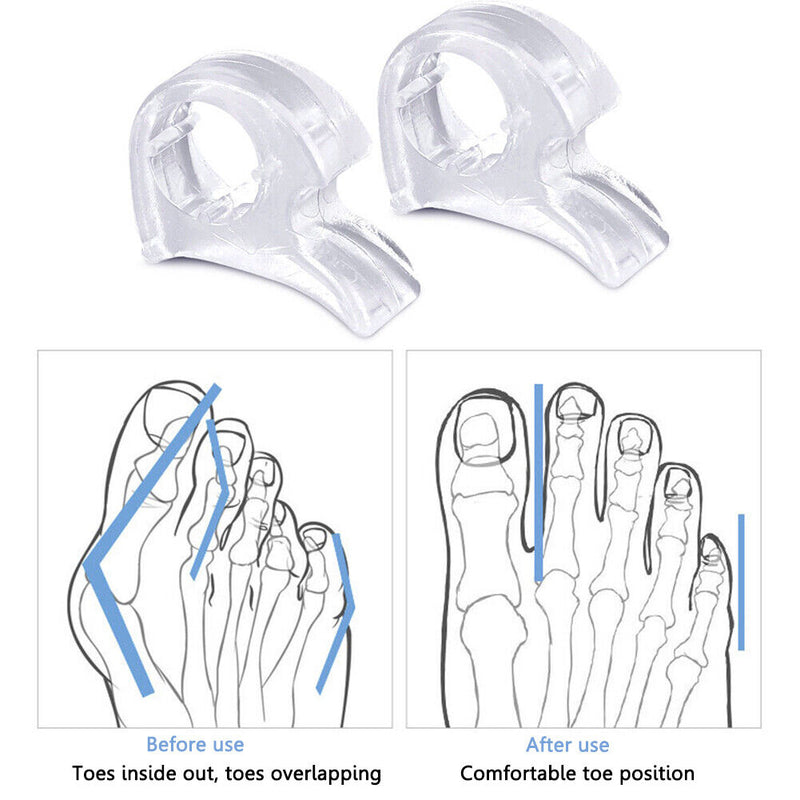 Silicone Feet Protector Bunion Corrector Hallux Valgus for Feet Care Pedicure