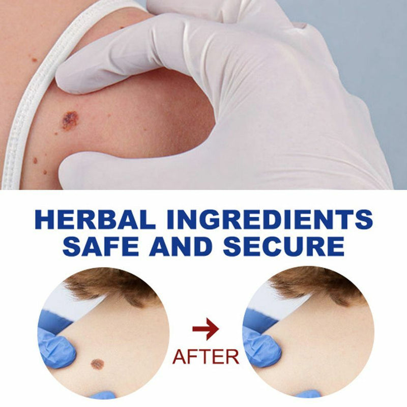 Of Warts Liquid Removing Against Moles Anti Verruca Remedy Warts Remover Pen