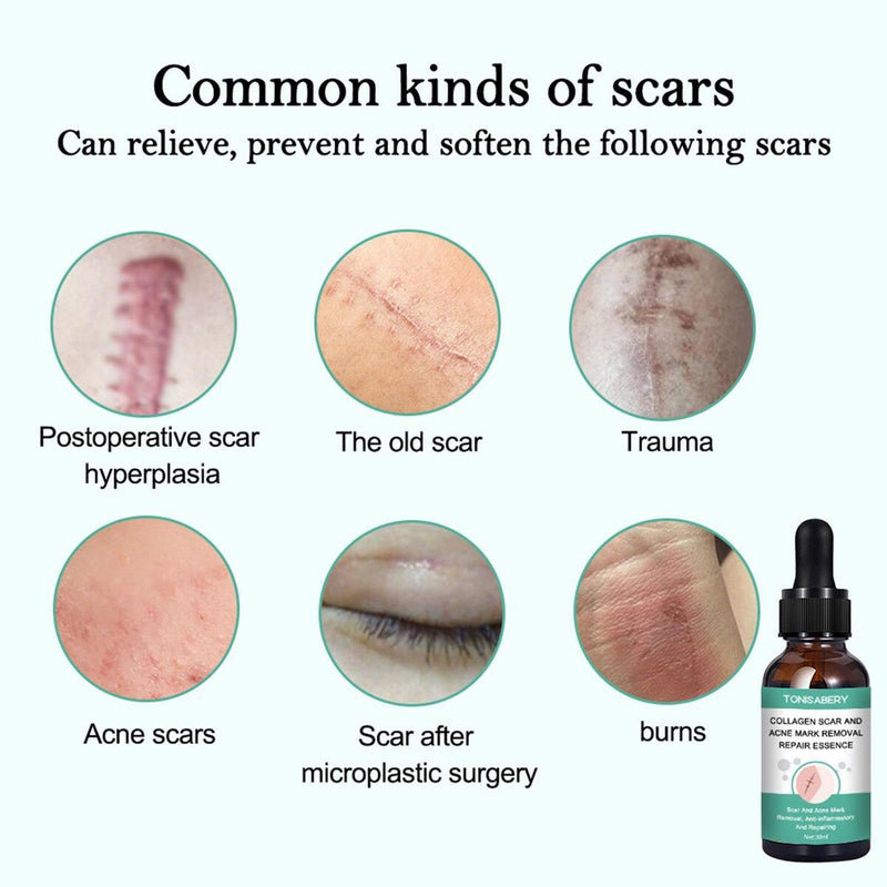 Narbenentfernung Ätherisches Öl Dehnungsstreifen Akneflecken Narbenchirurgie.