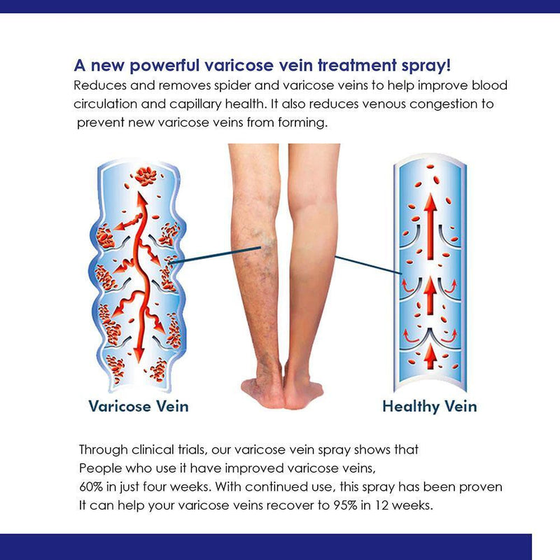 Varicose Vein Spray Blood Circulation Leg Acid Bilges Itching Solution 30ml