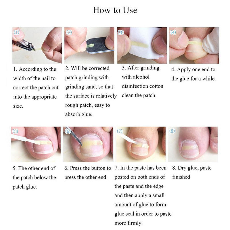 Grown Toenail Straightening Clip + Glue + Polish File Curved Brace Patch Kit