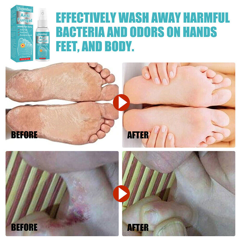 Anti Fungal Athlete Feet Spray Sterilize Infection Foot Toe Paronychia Trea