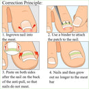 24pcs Nail Correction Tool Ingrown Toenail Paronychia Fixer Nail Paster Kit