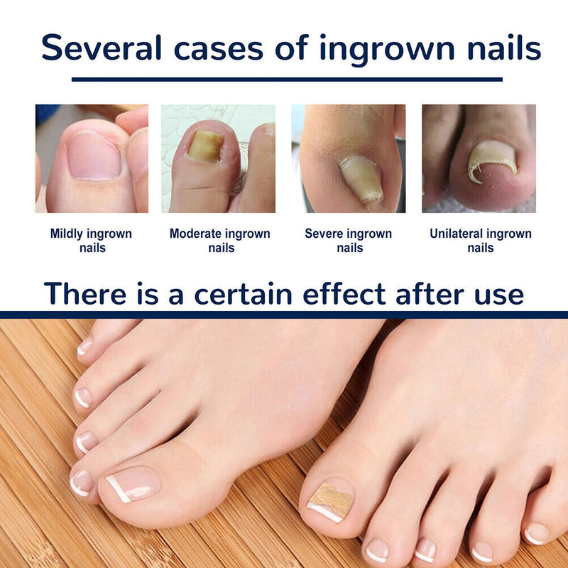 Visibly Effection Ingrown Toenail Stickers Paronychia Treatment Nail Care Tools
