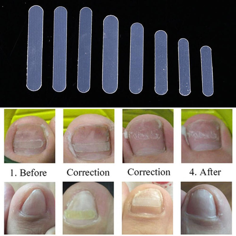 Ingrown Corrector Stickers Fingernail Toe Treatment Nail Care Repairing Patch