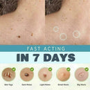 Micro Safe Skin Tag Remover Kit For Fast & Effective XAA Skin Tag 2021 R2V4