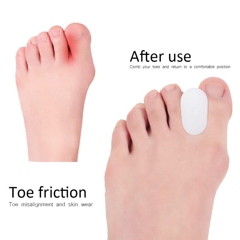 1 Pair 2pcs Toes Separator Ectropion Adjuster Bone Thumb Orthotics Corrector