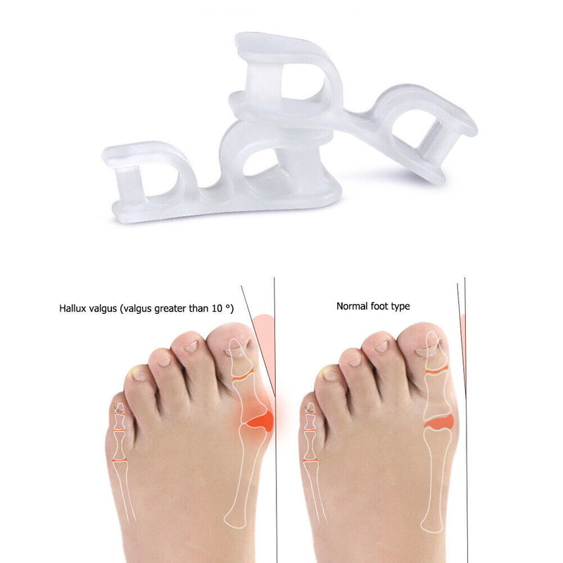 1 Pair Toe Separator Bunion Splint Hallux Valgus Overlapping Orthosis Prote