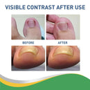 Ingrown Toenail Correction Stickers Nail Corrector Patches Nail Care Tool!