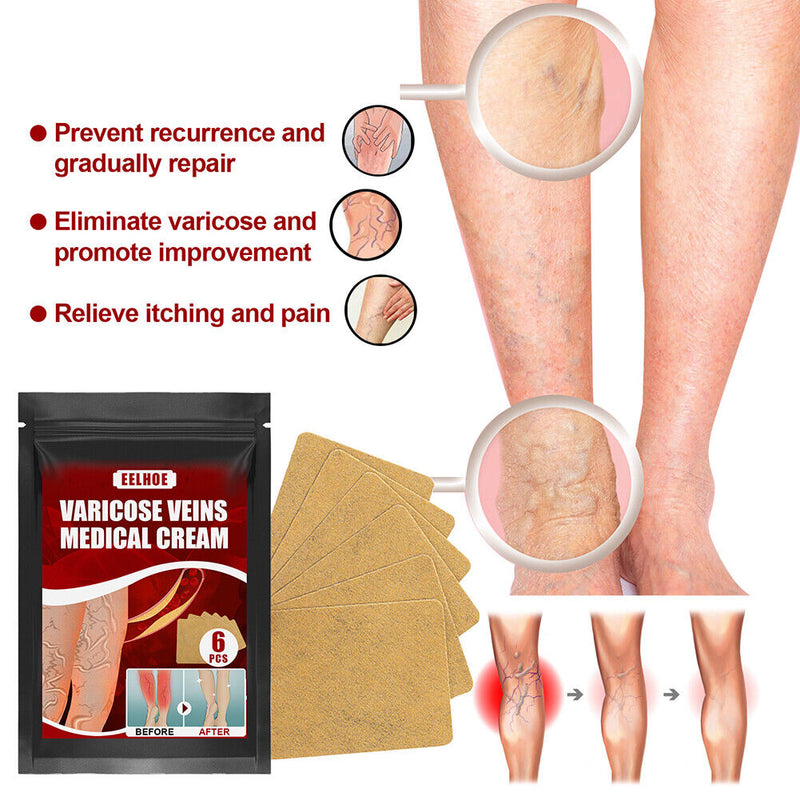 Body Vasculitis Phlebitis Spider Pain Relief Plaster Unisex Health Care Patch