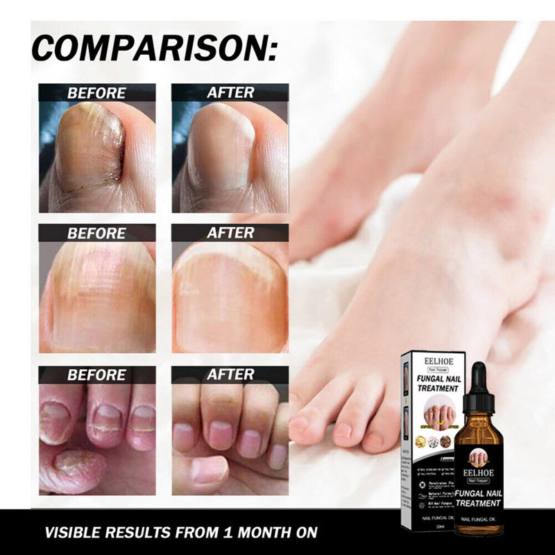Nail Repair Fluid Health Care Foot Treatment Onychomycosis Paronychia Improve