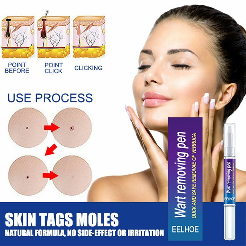 Of Warts Liquid Removing Against Moles Anti Verruca Remedy Warts Remover Pen