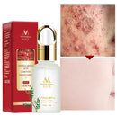 MEIYANQIONG Centella Asiatica Acne Removing Essence Skin Moisture Serum