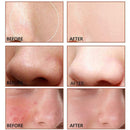 Salicylic Acid Essence Anti Remove Eye Pores Essence Women Bag 2021 Deep Q3Y6