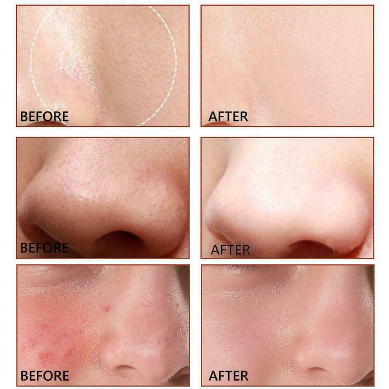 Salicylic Acid Essence Anti Remove Eye Pores Essence Women Bag 2021 Deep Q3Y6