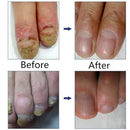 Anti Fungal Treatment Fungus Effective Finger Toe Nail Repair Liquid Solu F7X0