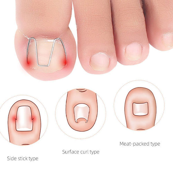Easy To Use Multiple Pedicure Correct Rubber Band Front Hook Orthotics Toenails