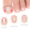 Easy To Use Multiple Pedicure Correct Rubber Band Front Hook Orthotics Toenails