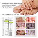 Gel Anti Infection Paronychia Treatment Toe Health Foot Care