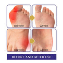 5pcs Bunion Gout Pain Relief Patch Toe Joint Valgus Hallux Knee Lumbar Arthritis