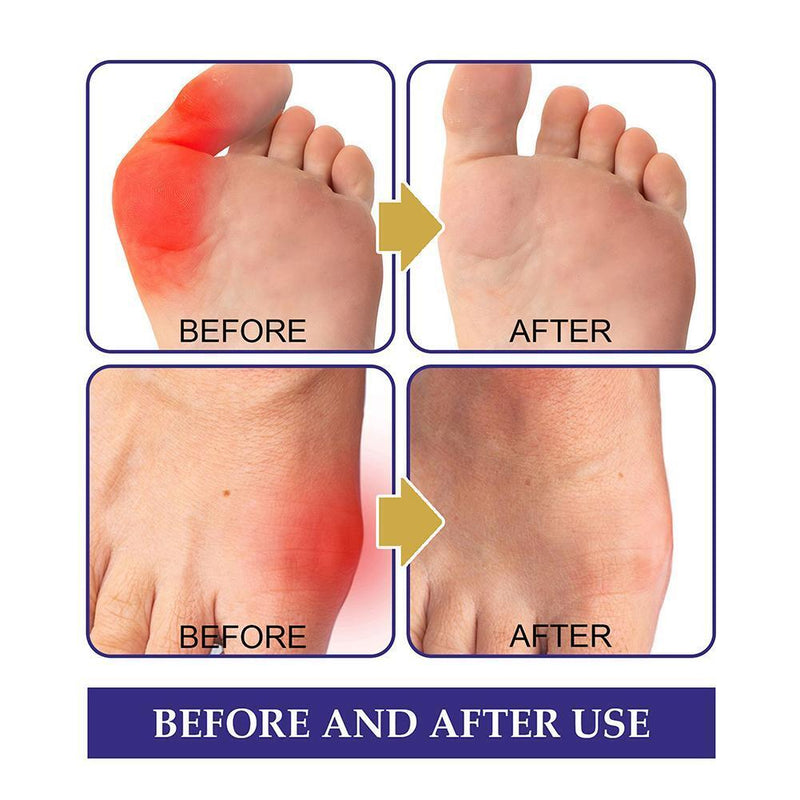 5pcs Bunion Gout Pain Relief Patch Toe Joint Valgus Hallux Knee Lumbar Arthritis