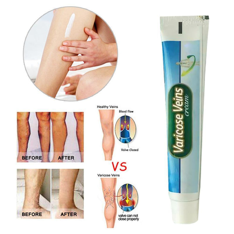 Ointment Vasculitis Phlebitis Spider Veins Pain Varicosity Remedy Herbal Cr